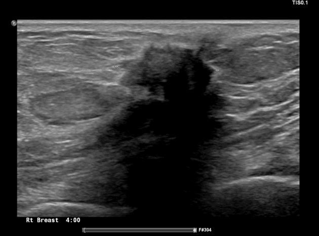 Invasive ductal carcinoma of the breast - grade 1