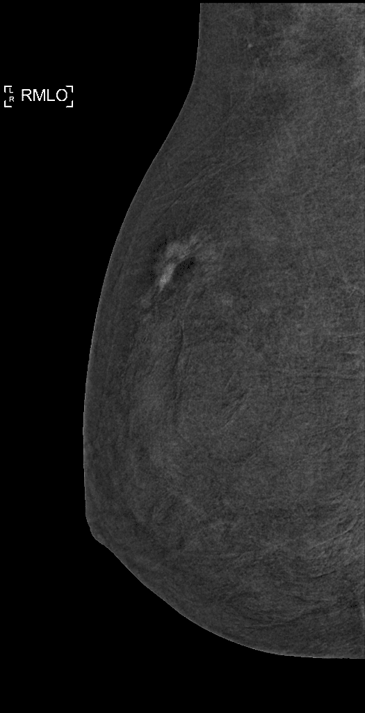 Invasive ductal carcinoma of the breast - grade 2
