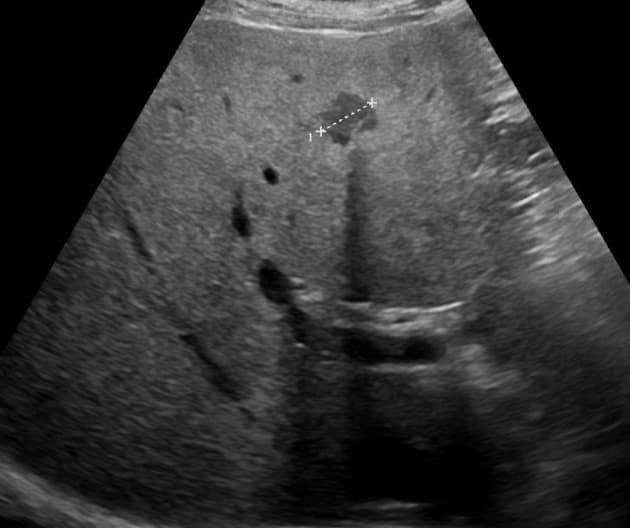 Multifocal focal fatty sparing in a steatotic liver