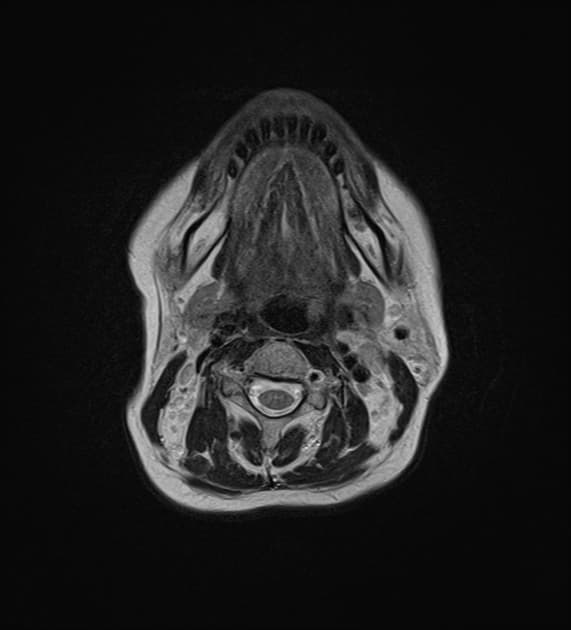 Chiari 1 malformation