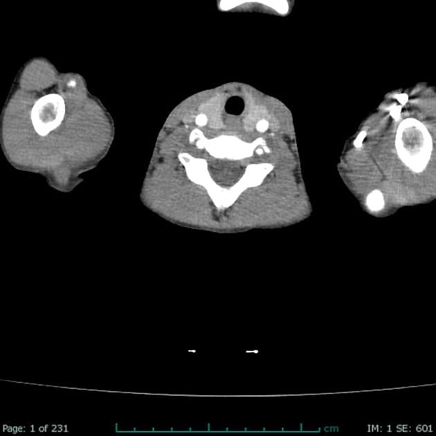 Abdominal tuberculosis