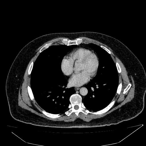 Bosniak Class III Renal Cyst and Multiple Biliary Hamartomas (U nang thận phân loại Bosniak III và nhiều tổn thương u sợi tuyến mật lành tính (biliary hamartomas))