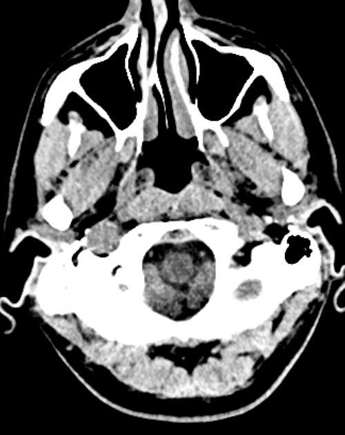 Intracranial fungal granuloma mimicking meningioma