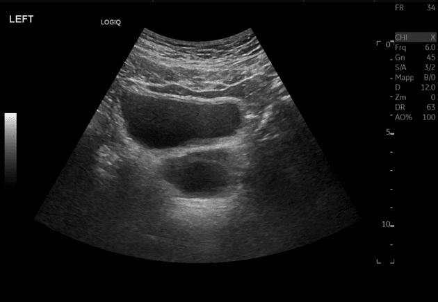 Symptomatic müllerian duct cyst