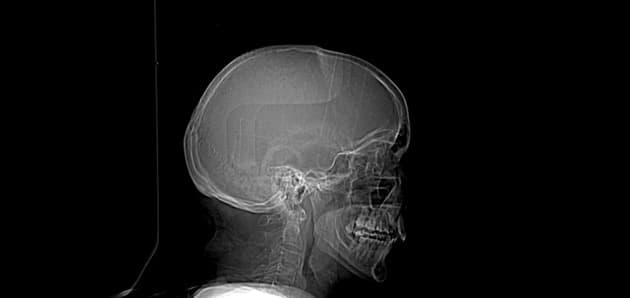 Right MCA territory infarct with dense MCA sign