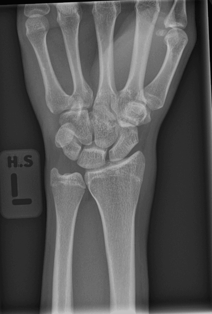 Epiphyseal Spur of the Distal Radius (Gai xương sụn tiếp hợp)