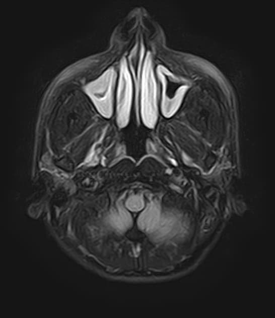 Subcortical and subependymal heterotopia (Dị dạng vị trí hạch dưới vỏ và dưới biểu mô não thất)