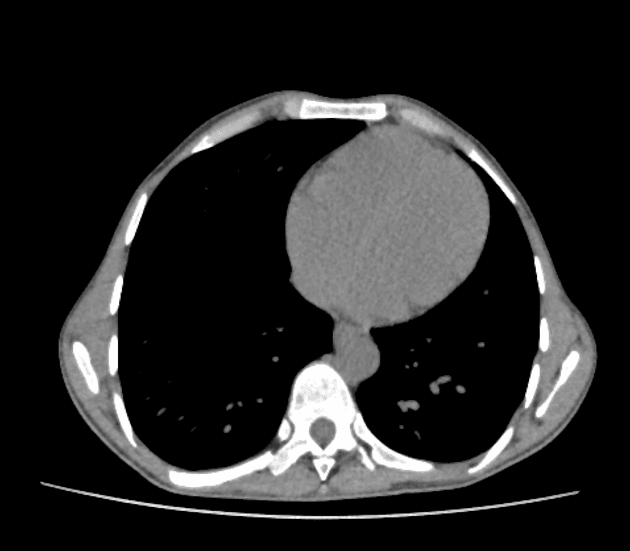 Hepatic Neuroendocrine Tumor (U thần kinh nội tiết gan)