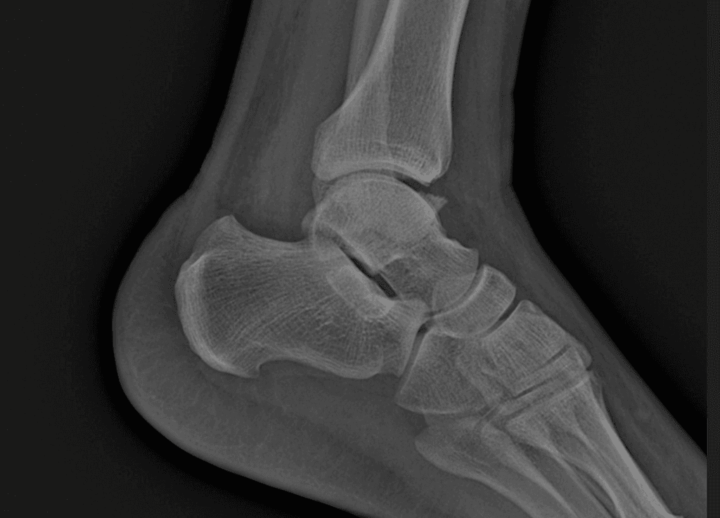 Transverse Fracture of the Medial Malleolus (Gãy lồi cầu trong)