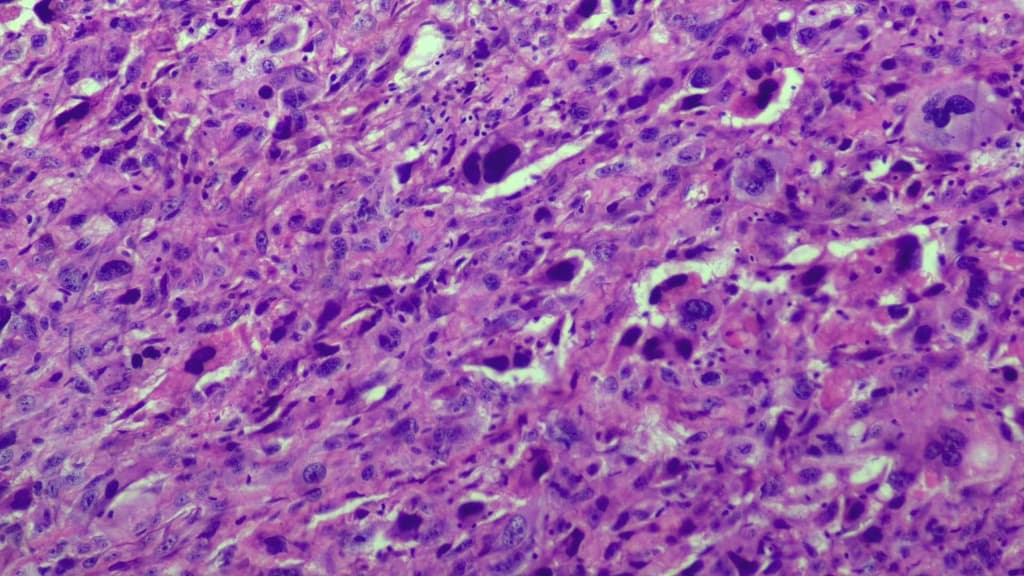 Calcaneal Osteosarcoma (U xương ác tính xương gót chân)