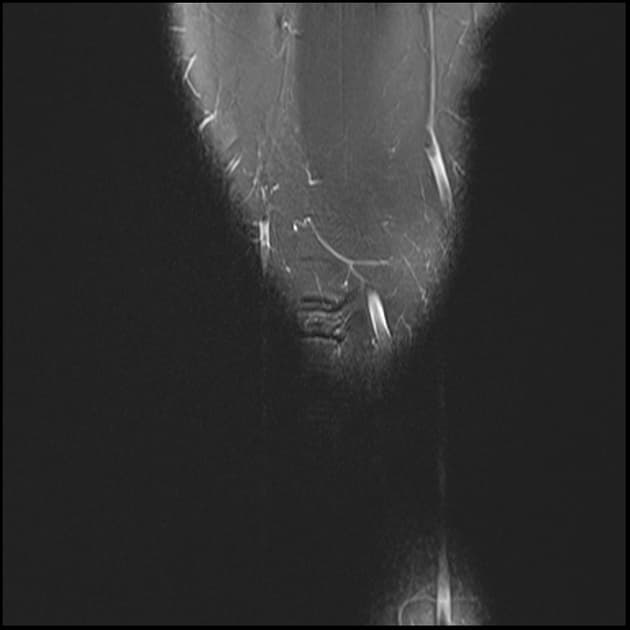 Bucket Handle Tear of the Medial Meniscus (Xé dạng tay xô sụn chêm trong)
