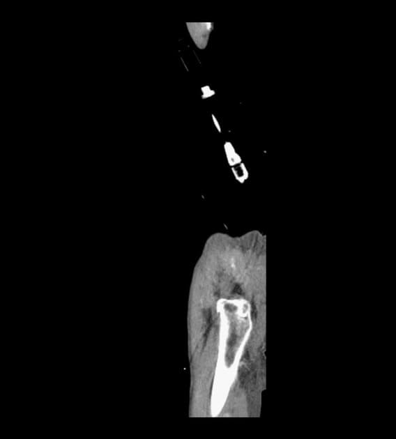 Inferior Vena Cava Laceration Following Blunt Trauma (Vết rách tĩnh mạch chủ dưới)