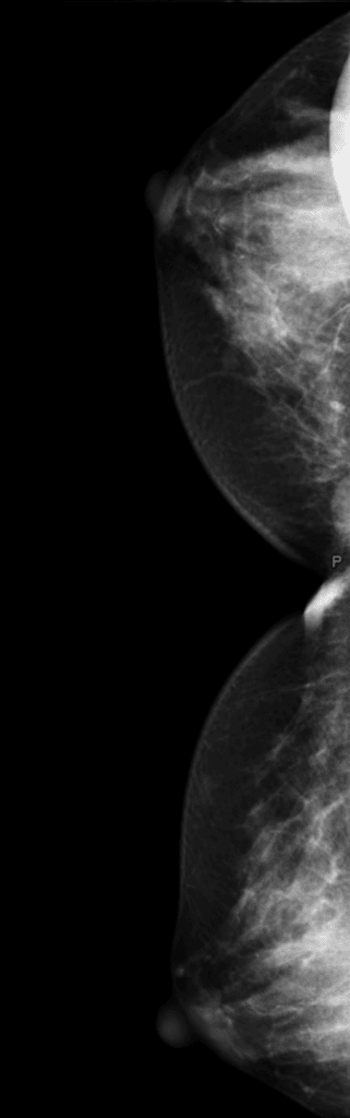 Fibroadenoma (Adenoma vú)