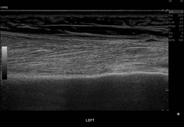 Secondary Lymphedema Following Radical Hysterectomy and Bilateral Lymph Node Dissection (Bệnh lý bạch huyết (Lymphedema))