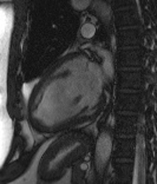 Left ventricular apical thrombus