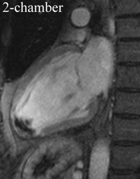 Left ventricular apical thrombus