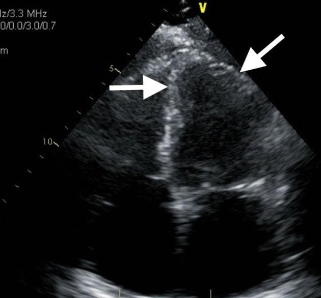 Takotsubo cardiomyopathy (echocardiography)