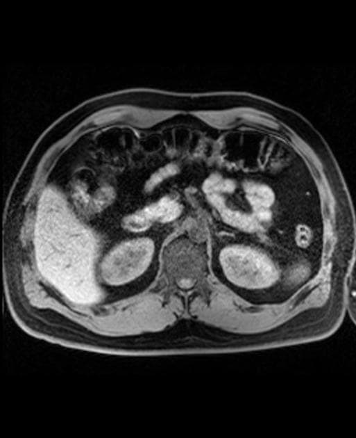 Insulinoma (Insulinoma)