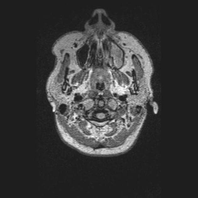 Advanced Multiple Sclerosis (Xơ cứng rải rác: giai đoạn tiến triển)