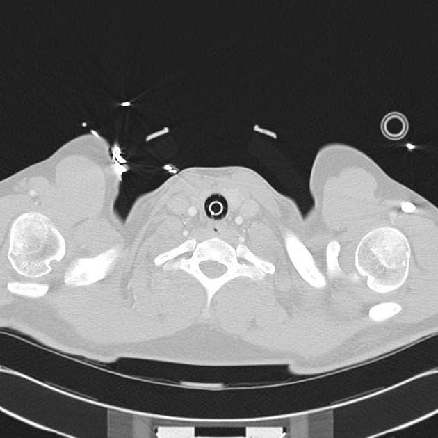 Aspiration Pneumonia in a Trauma Patient (Viêm phổi hít do chấn thương)