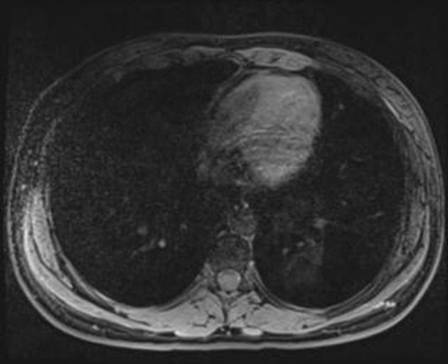 Focal Nodular Hyperplasia on Primovist MRI and 4-Phase CT (Tăng sản khu trú dạng nốt trên cộng hưởng từ Primovist và cắt lớp vi tính 4 thì)