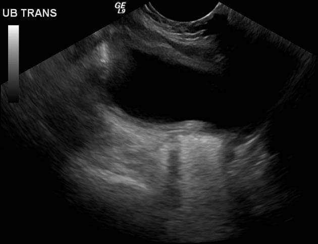 Prostatic utricle cyst