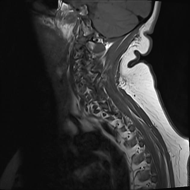 Multiple Sclerosis with Disseminated White Matter and Spinal Cord Lesions (Xơ cứng rải rác)