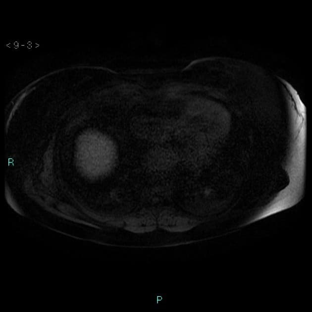 Multiple liver adenomas with signs of bleeding