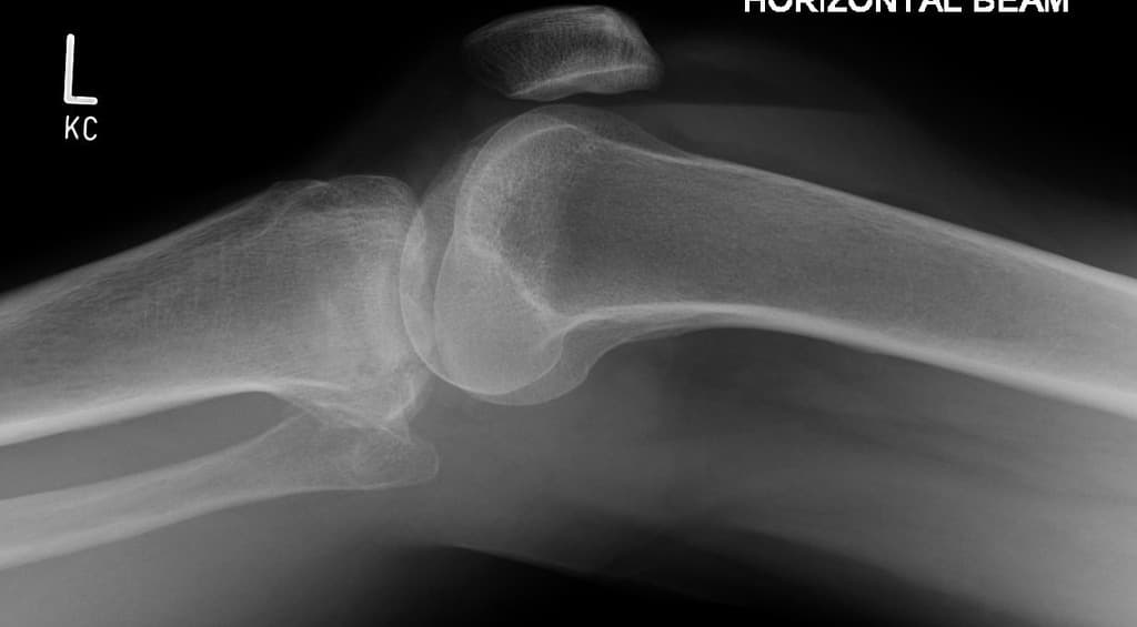 Lateral Tibial Plateau Fracture with Lipohemarthrosis (Gãy lồi cầu ngoài xương chày)