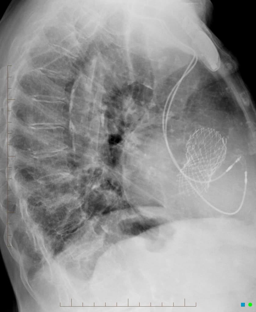 Percutaneous transcatheter aortic valve replacement