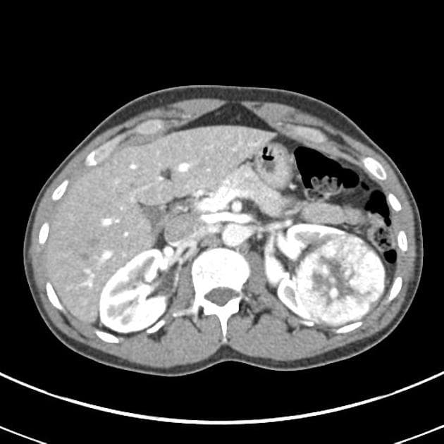 Renal Oncocytoma (U oncocytoma thận)