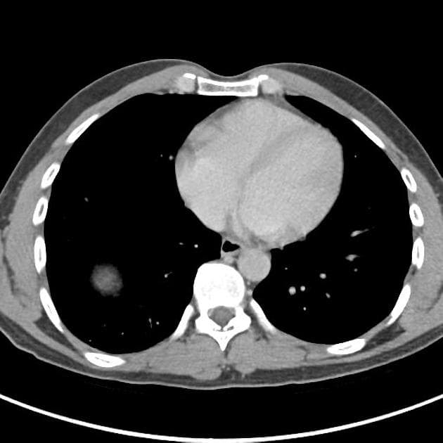 Renal Oncocytoma with Central Stellate Scar (U tế bào hạt thận (Renal oncocytoma))