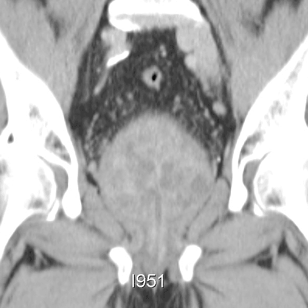 Benign Prostatic Hyperplasia (Phì đại tuyến tiền liệt lành tính)